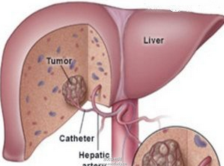 中晚期肝癌介入治療的方法有哪些