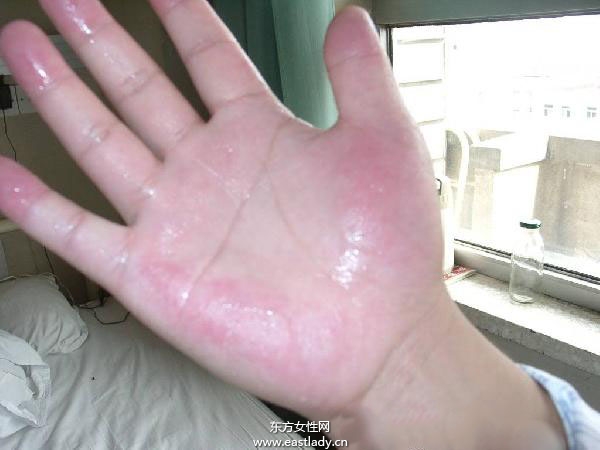 手腳出汗是怎么回事 應(yīng)該如何治療呢