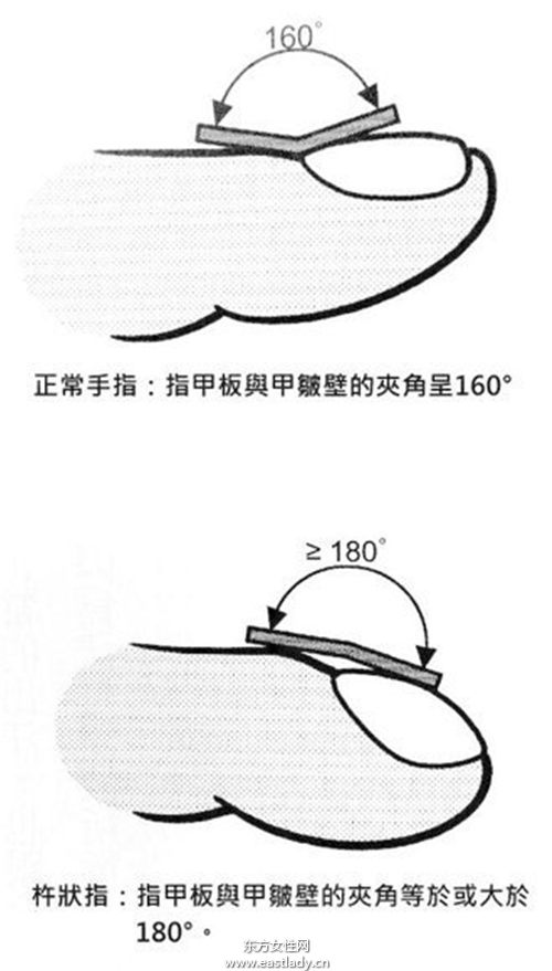 中醫(yī)從 手指 看出心臟疾病