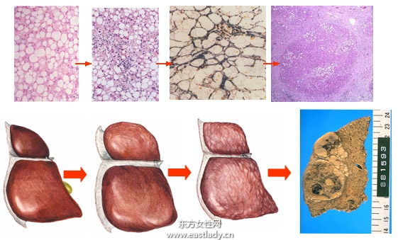 老中醫(yī)手把手教你應當如何治療肝病