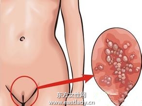 女性尖銳濕疣早期癥狀有哪些