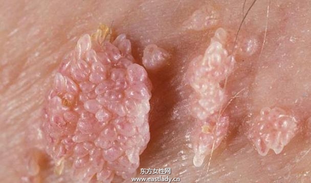 尖銳濕疣的潛伏期有多長(zhǎng)時(shí)間