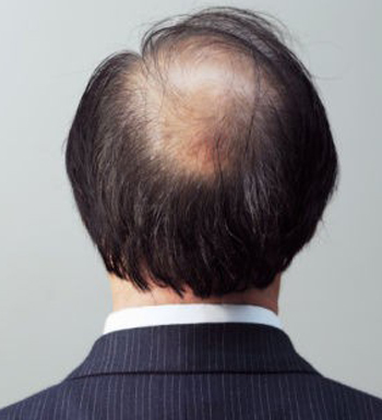 男人為什么會(huì)脫發(fā) 男人頭發(fā)會(huì)變少的8個(gè)原因