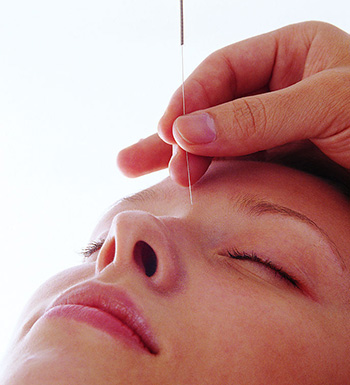 中醫(yī)針灸的功效及注意事項(xiàng)有哪些