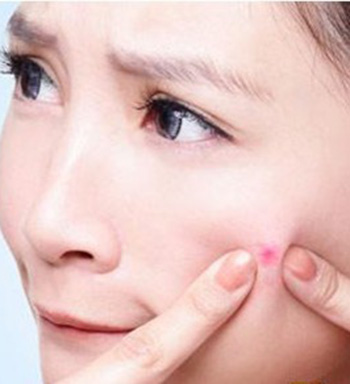 長痘痘不能吃什么 杜絕這些食物遠離痘痘