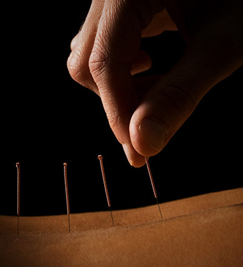 中醫(yī)針灸的功效及注意事項(xiàng)有哪些