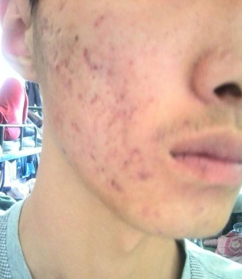 你該知道如何去除痘坑的幾種方法