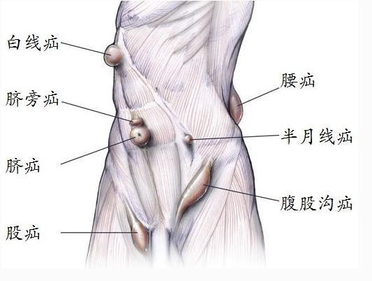 腹股溝疼痛 六種癥狀你要警惕