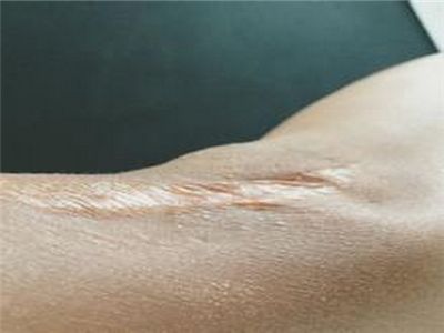 討厭的疤痕快走開，怎么修復(fù)疤痕