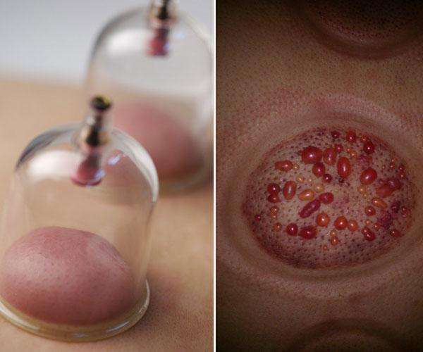 中醫(yī)拔罐的種類以及功效你了解嗎