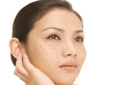 民間祛斑秘方 這10個方法讓你不在煩惱