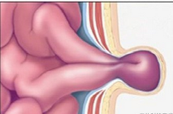 腹股溝疼痛 六種癥狀你要警惕