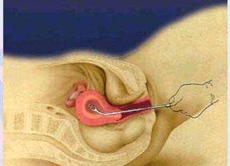 最后的補(bǔ)救措施 人流后多久可以出門