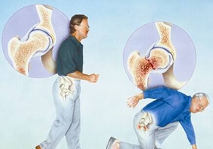 骨質(zhì)疏松的需要補(bǔ)充的營(yíng)養(yǎng)元素介紹