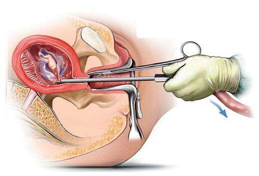 四大人工流產(chǎn)方式你知道嗎