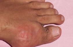 痛風的癥狀及治療  進低嘌呤低能量飲食