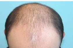 頭發(fā)少怎么辦  治療脫發(fā)的偏方