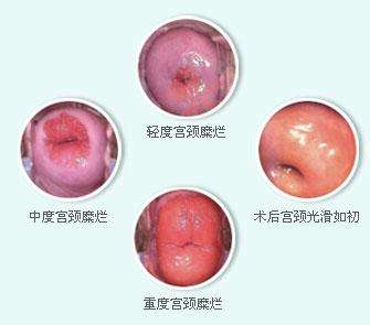 造成輕度宮頸糜爛的主要原因以及它的癥狀是什么