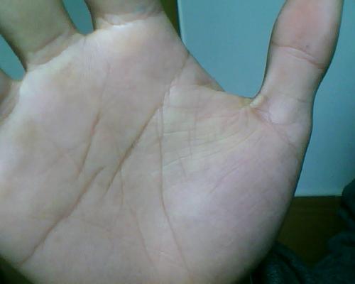 手脫皮怎么辦，三招立馬解決