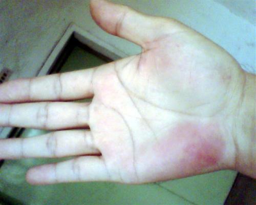 手脫皮怎么辦，三招立馬解決