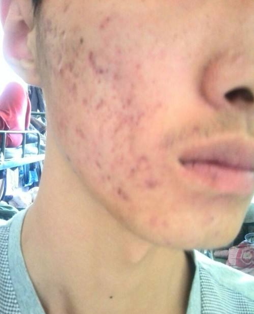 痘印怎么消除小妙招，這四種你要知道