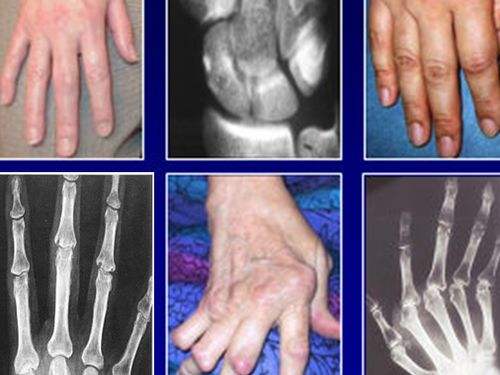 風(fēng)濕和類風(fēng)濕的區(qū)別你都知道嗎