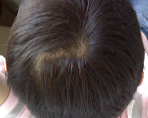 怎樣去頭皮屑，全方位為你解答