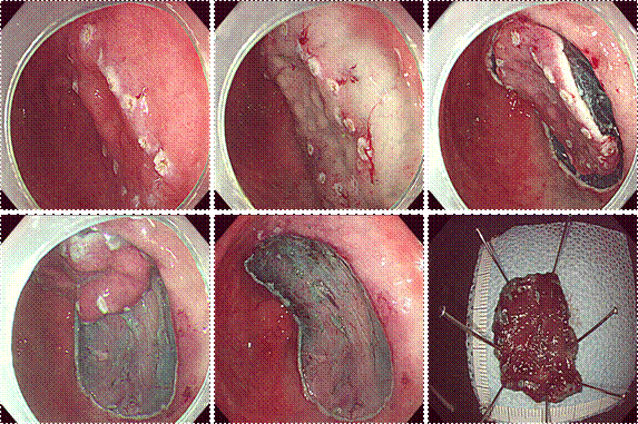 癌癥早發(fā)現(xiàn)早治療 胃癌早期癥狀