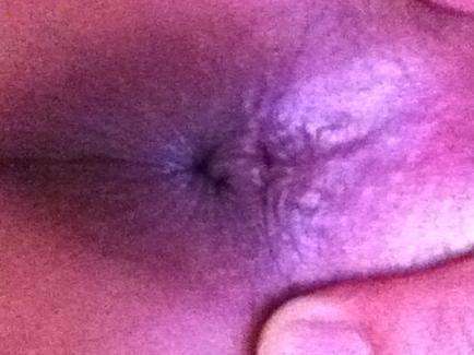 十男九痔之外痔瘡