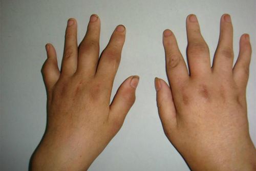 風(fēng)濕和類風(fēng)濕的區(qū)別你都知道嗎