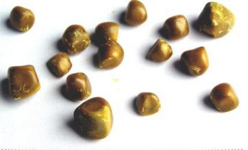 腎結(jié)石是什么？腎結(jié)石怎么治最好