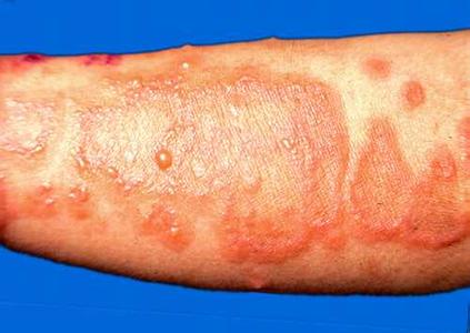 各種皮膚病治療的小偏方 讓你快速康復