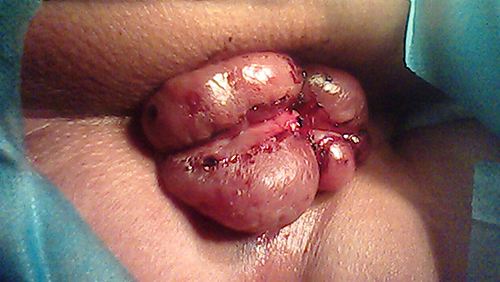 十男九痔之外痔瘡