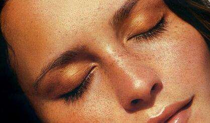 得了老年斑不可怕，老年斑有消除辦法