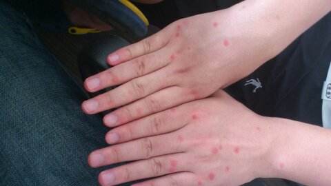 撓撓撓皮膚瘙癢起紅疙瘩怎么辦