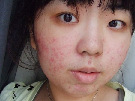 皮膚過敏怎么辦 這6種偏方幫助你康復