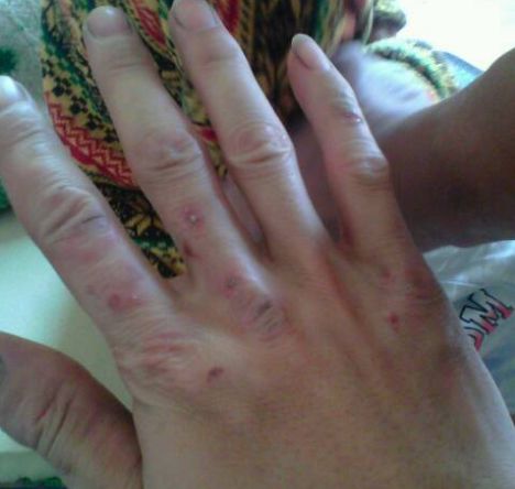 濕疹怎么辦 治療濕疹的偏方讓你遠離該病