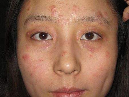 濕疹怎么辦 治療濕疹的偏方讓你遠離該病