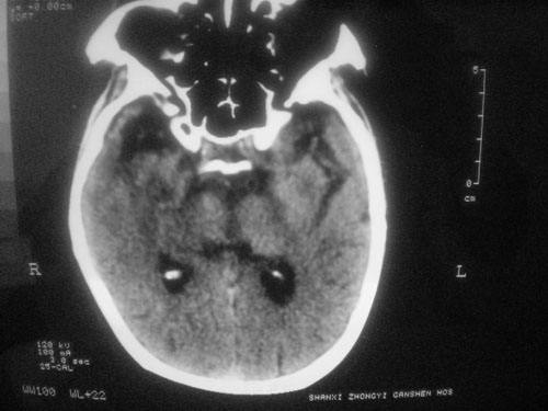 腦供血不足的癥狀會怎樣損害我們的CPU