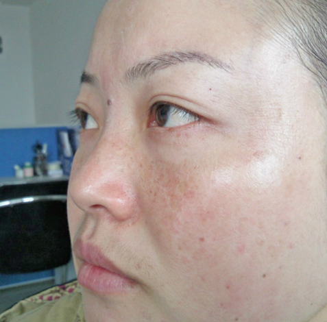 蝴蝶斑是怎么形成的  兩大因素