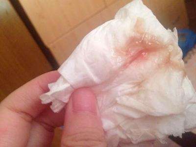 白帶異常怎么辦及正常白帶是什么樣的介紹