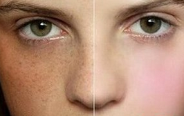 蝴蝶斑是怎么形成的  兩大因素