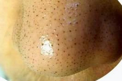 鼻子上有黑頭怎么辦  教你幾招