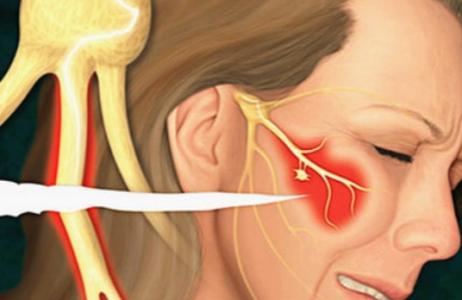 大腦路線  三叉神經(jīng)痛癥狀