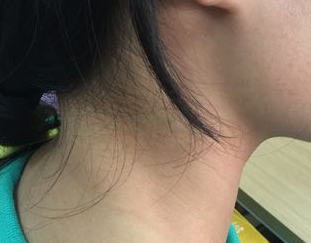 折磨人的咽喉炎，咽喉炎癥狀有哪些