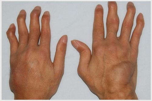 類風(fēng)濕關(guān)節(jié)炎偏方 讓你更快恢復(fù)