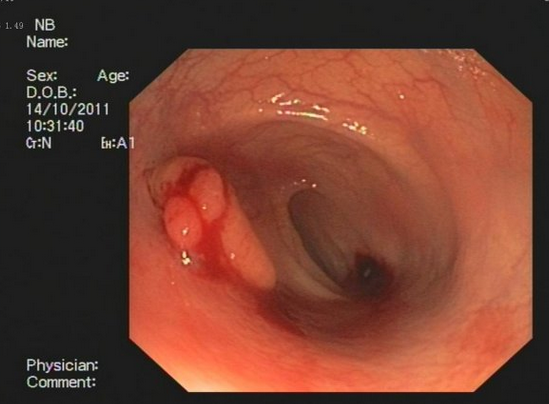 腸鏡檢查 六種方法你懂嗎