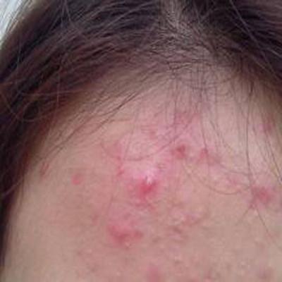 額頭長痘痘怎么調(diào)理 教你幾招祛痘方法