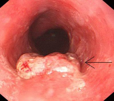 魔鬼病毒 食道癌的早期癥狀