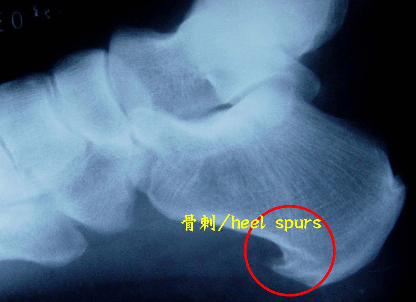 骨刺到底是不是病，治療骨刺的偏方